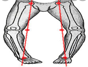 تصحيح تشوهات العظام للبالغين 