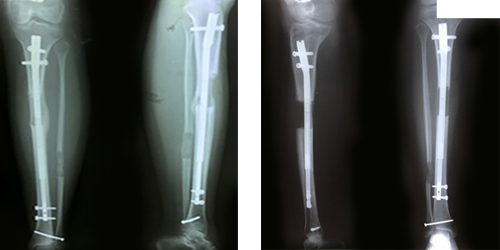 الصياد لجراحة العظام