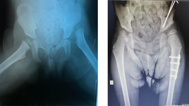 خلع الاطفال