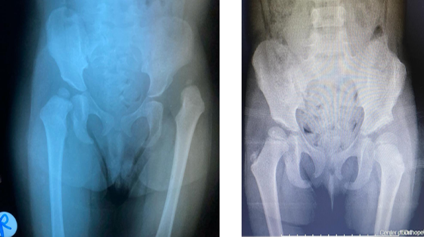 خلع الاطفال